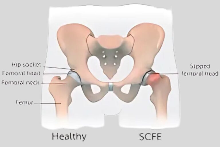 SCFE (Slipped Capital Femoral Epiphysis) - Services