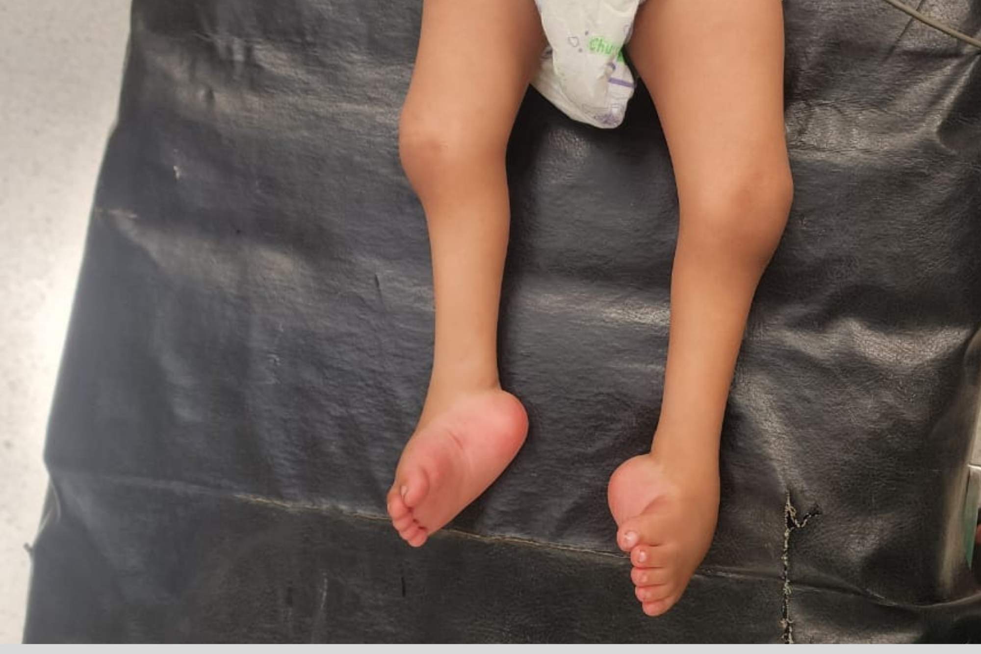 CTEV (Clubfoot) - Services