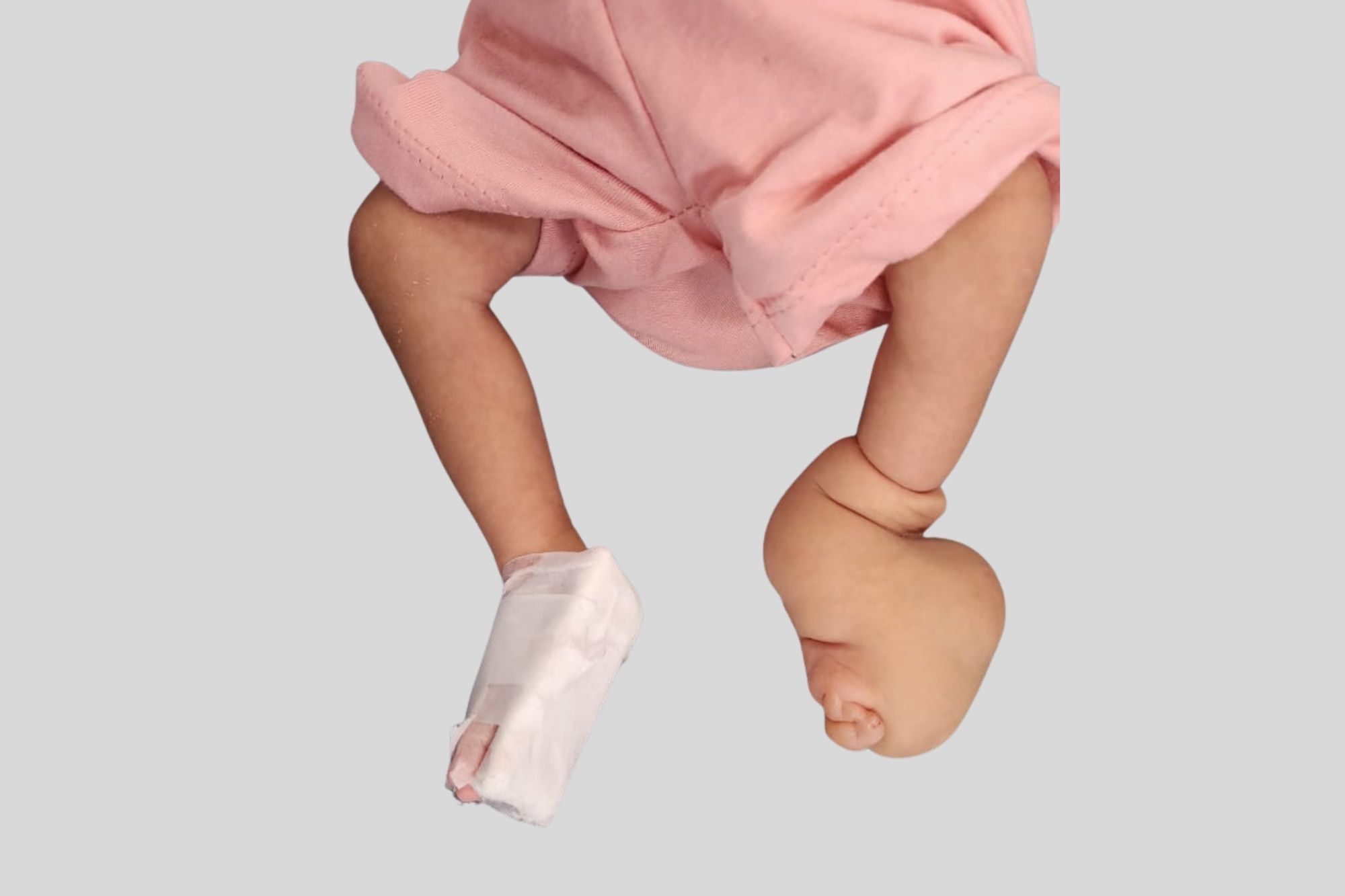 Congenital Constriction Ring Syndrome - Services