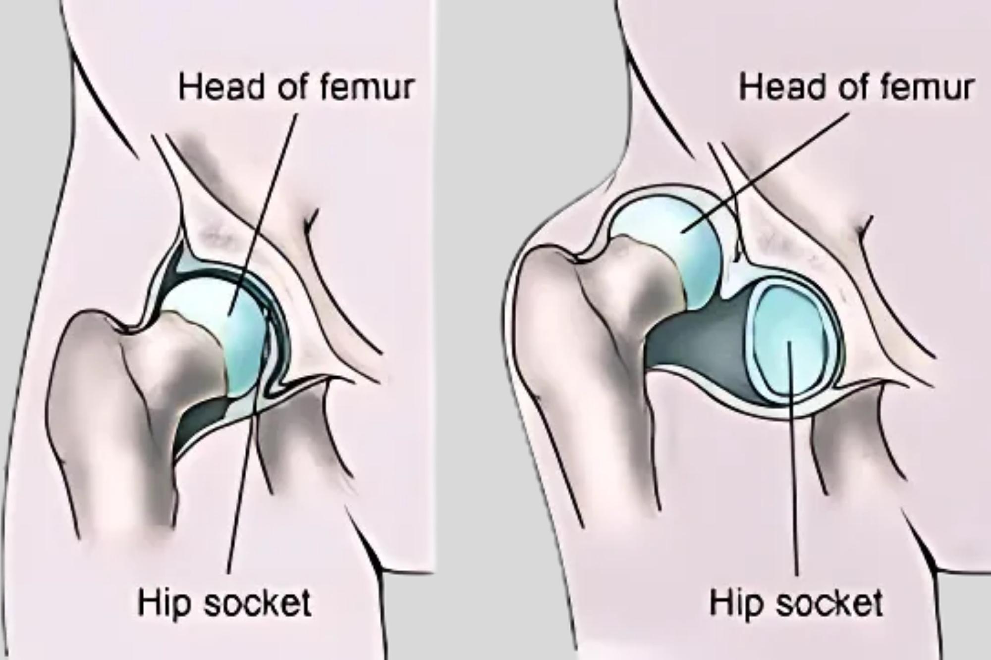 Developmental Dysplasia of the Hip (DDH) - Services