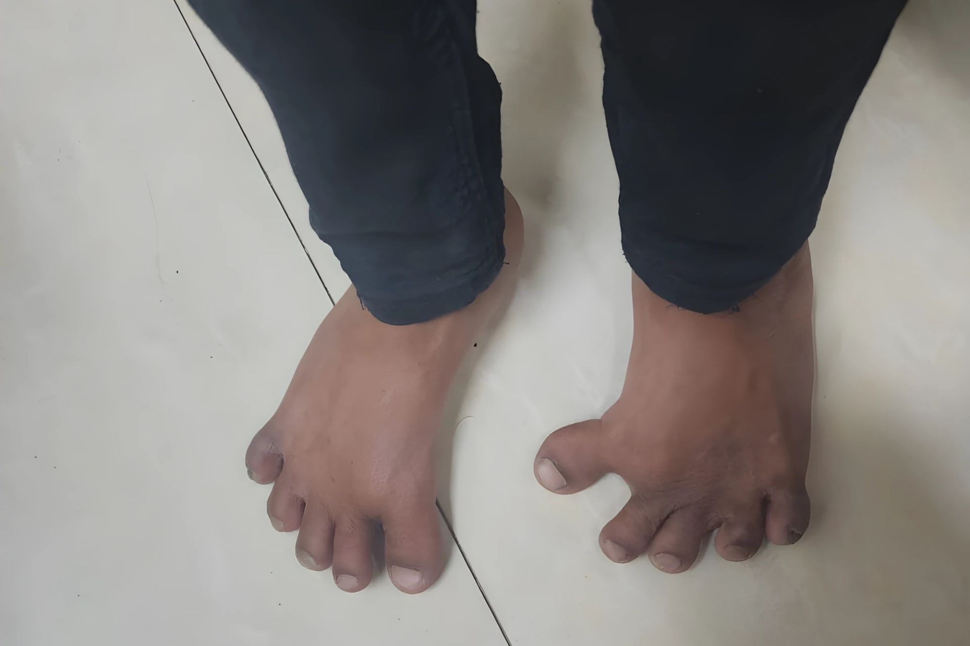 Hallux Varus - Services