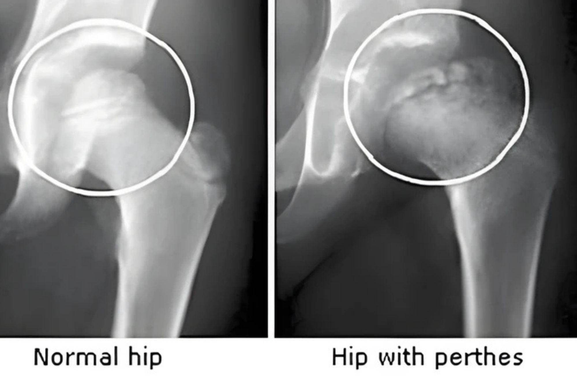 Perthes Disease - Services