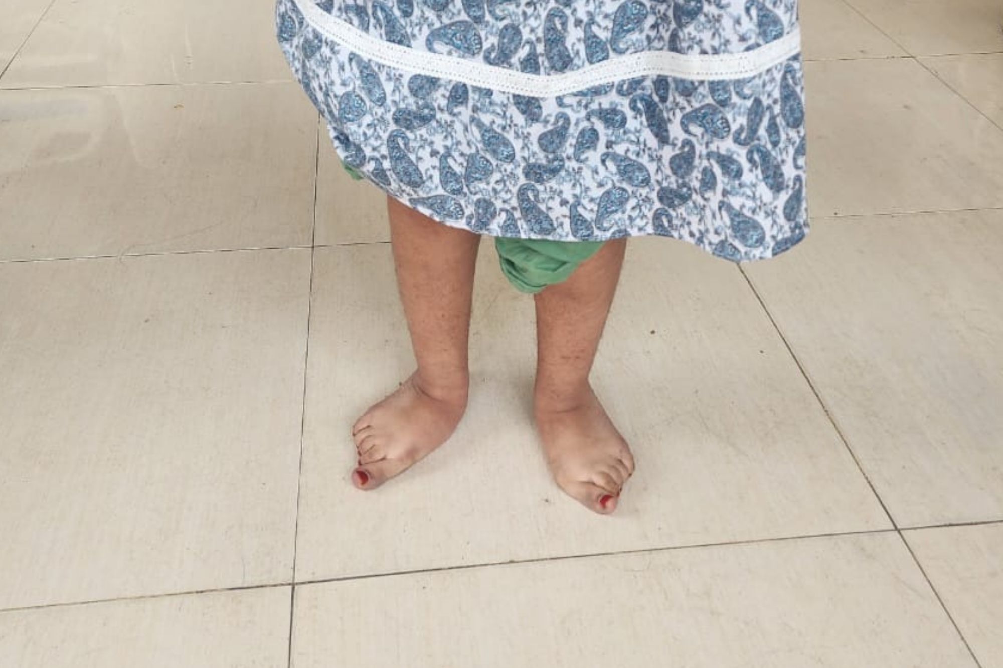 Planovalgus Foot (Flatfoot) - Services